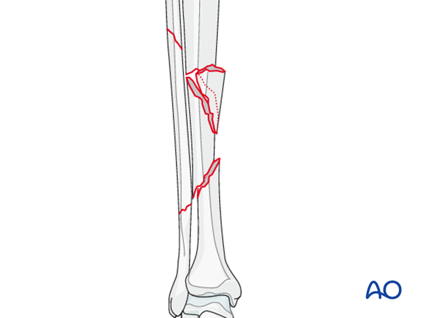 C2 tibial shaft fracture