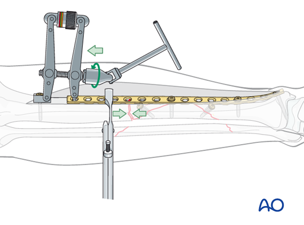 The articulated tension device (ATD) is used to compress the transverse fracture and complete the fixation. 
