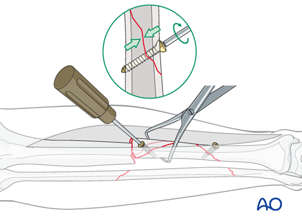 Once the fracture is reduced, a lag screw can be used to secure the final reduction.