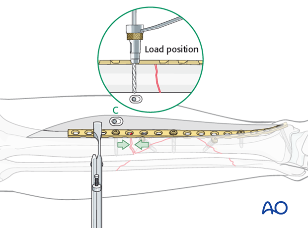 Now, with the fracture reduced and plate properly positioned, drill eccentrically (load position) for the first screw...