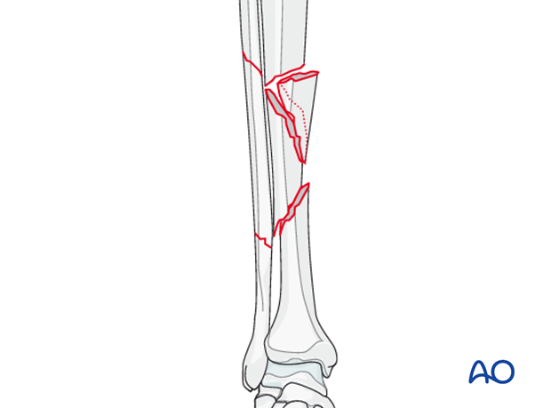C2 tibial shaft fracture