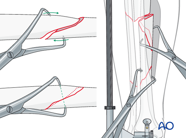 Reduction of the wedge fragments and oblique fracture lines can be done with a pointed reduction forceps.