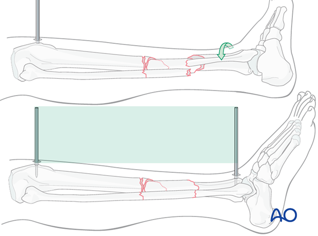 Rotational alignment must be considered during application of the previous reduction method. 