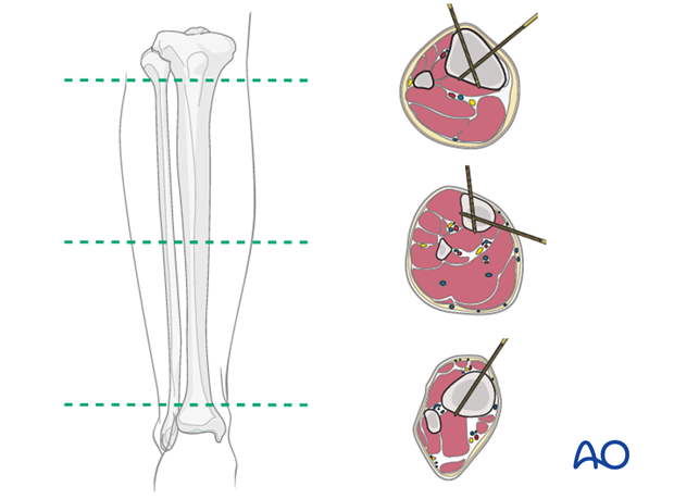 Orthopedic Instrument Trauma Tibial External Fixator System for Tibia  Fracture - China Synth External Fixation, External Fixator