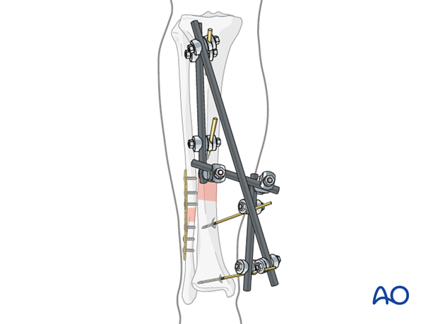 Orthopedic Instrument Trauma Tibial External Fixator System for Tibia  Fracture - China Synth External Fixation, External Fixator