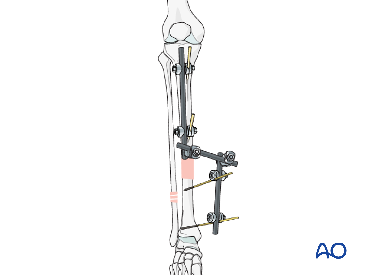 Modular External Fixator For Simple Fracture, Spiral