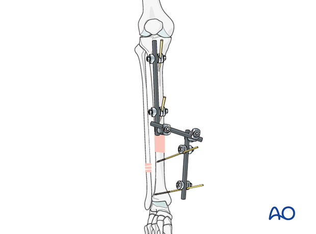 Orthopedic Instrument Trauma Tibial External Fixator System for Tibia  Fracture - China Synth External Fixation, External Fixator