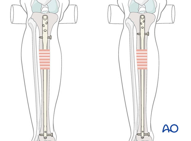 Infrapatellar intramedullary nailing, reaming
