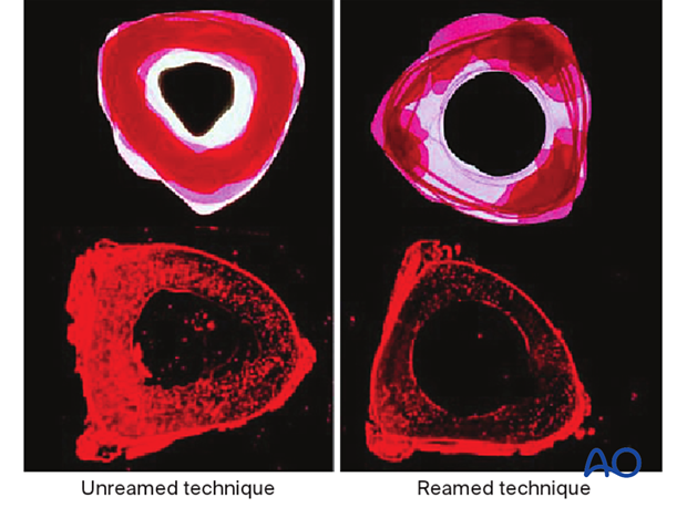 Lateral parapatellar intramedullary nailing of the tibial shaft, reaming