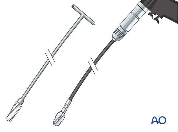 Infrapatellar intramedullary nailing, reamers