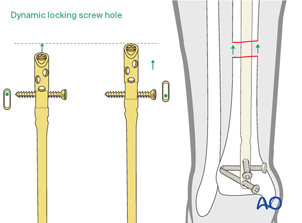 Infrapatellar intramedullary nailing, locking screws