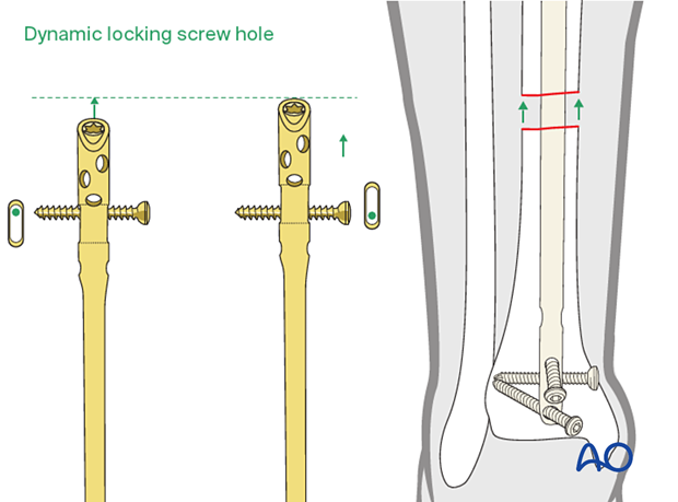 Circular external fixator application for midshaft tibial