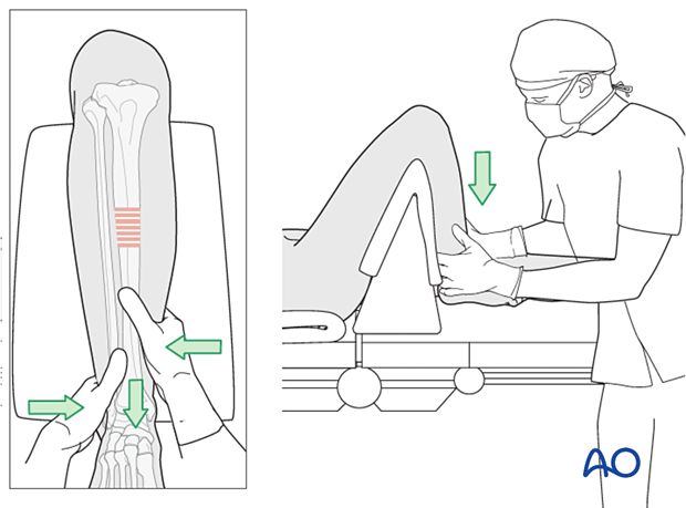 Infrapatellar intramedullary nailing, manual traction