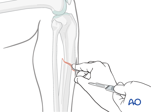 Infrapatellar intramedullary nailing, open reduction