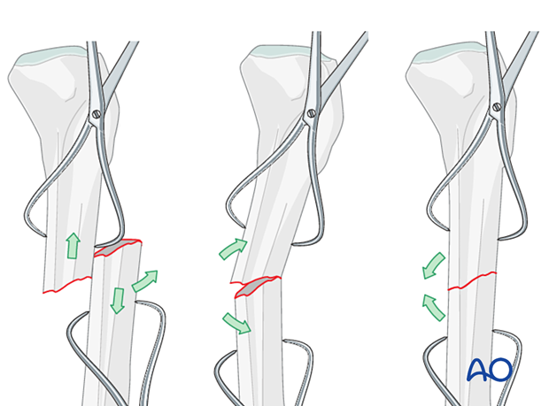 Infrapatellar intramedullary nailing, transverse fractures