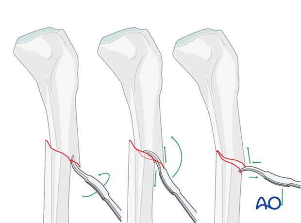 Infrapatellar intramedullary nailing, transverse fractures