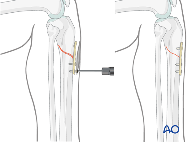 Lateral parapatellar intramedullary nailing of the tibial shaft, Reduction and preliminary fixation