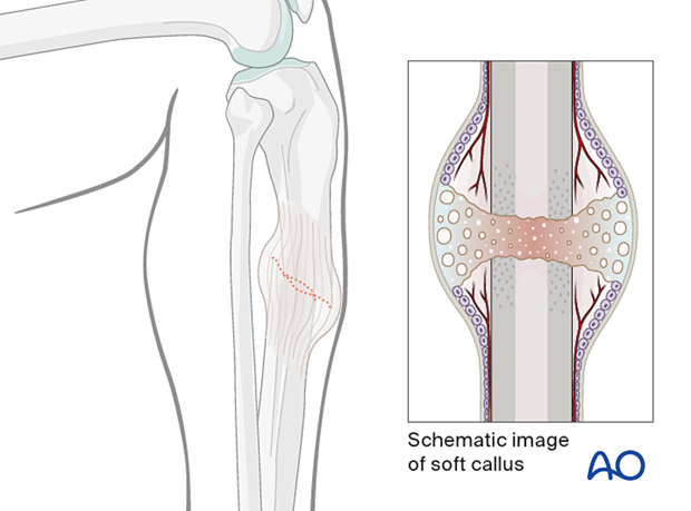 Lateral parapatellar intramedullary nailing of the tibial shaft, Reduction and preliminary fixation