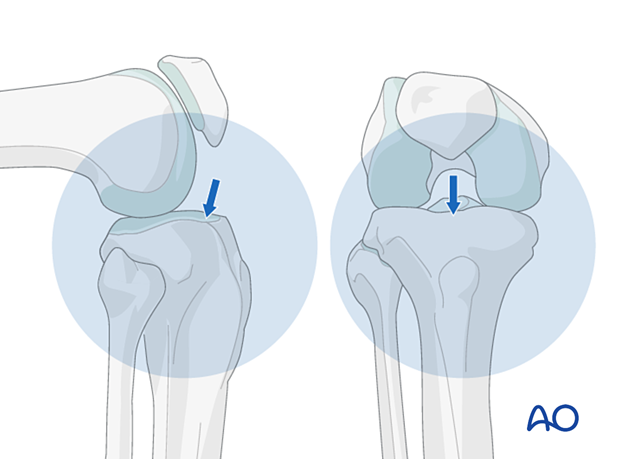 Lateral parapatellar intramedullary nailing of the tibial shaft, Nail entry site
