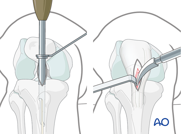 Infrapatellar intramedullary nailing, nail entry site