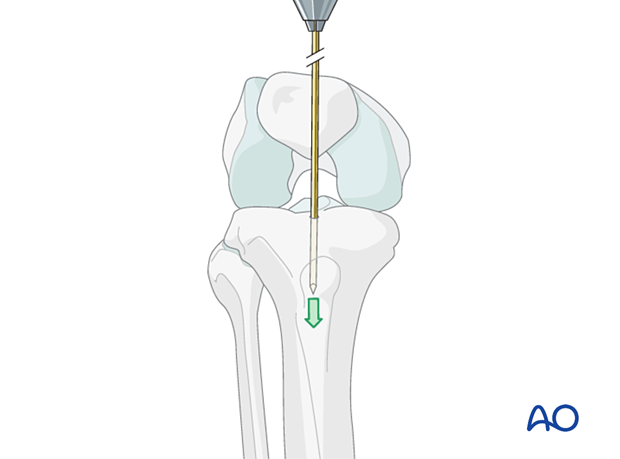 Infrapatellar intramedullary nailing, nail entry site