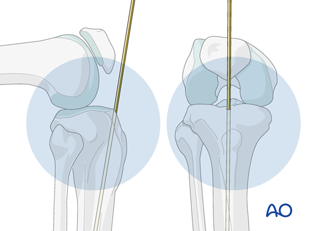 Infrapatellar intramedullary nailing, nail entry site