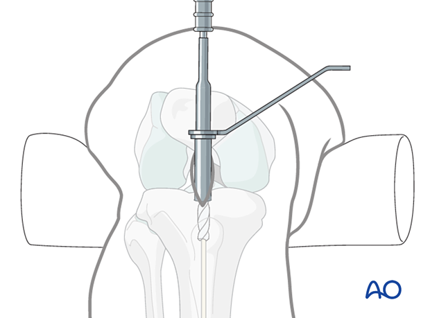 Infrapatellar intramedullary nailing, opening the cortex and proximal tibia