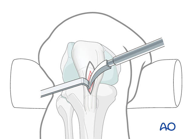 Infrapatellar intramedullary nailing, curved solid awl