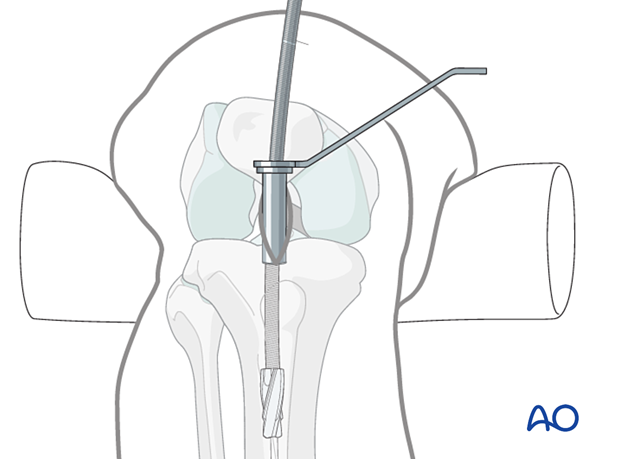 Infrapatellar intramedullary nailing, reaming and determination of nail diameter