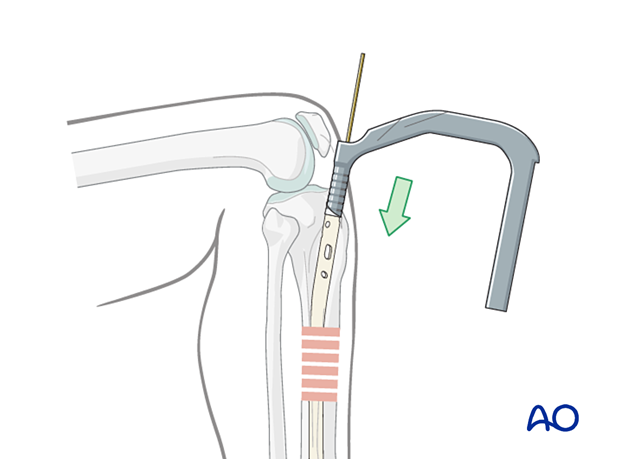 Infrapatellar intramedullary nailing, insertion of the cannulated nail