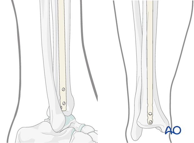 Lateral parapatellar intramedullary nailing of the tibial shaft, Cannulated nail