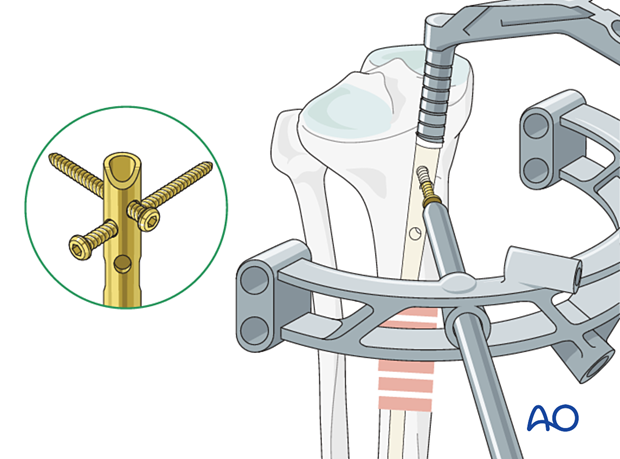Infrapatellar intramedullary nailing, locking of the nail