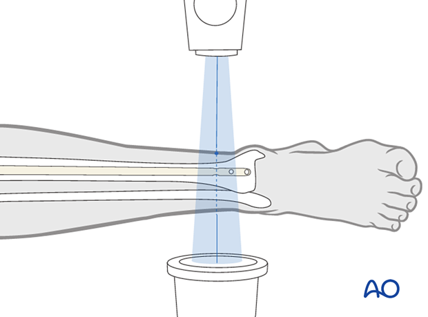 Infrapatellar intramedullary nailing, locking of the nail