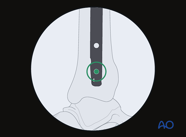 Lateral parapatellar intramedullary nailing of the tibial shaft, Cannulated nail