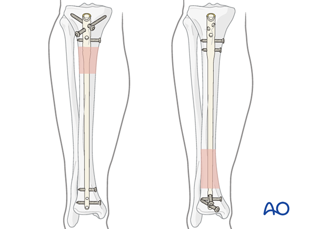 Infrapatellar intramedullary nailing, locking of the nail