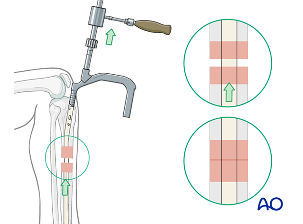 Infrapatellar intramedullary nailing, locking of the nail