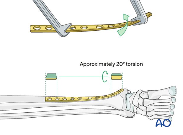 Bridge plating – Plate selection and preparation mio bridge plating, contouring