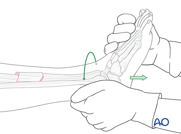 Bridge plating – Manual traction