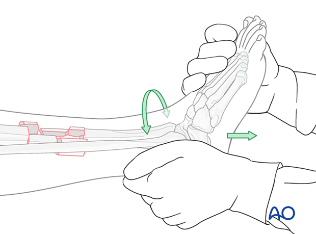 Bridge plating – Manual traction