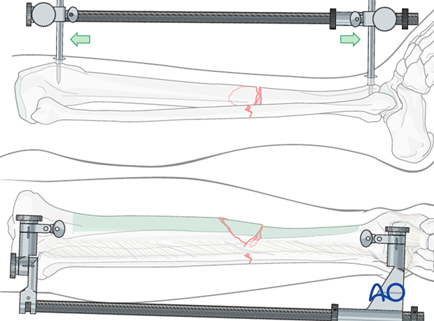 If manual traction is not successful, use a large distractor for closed reduction.