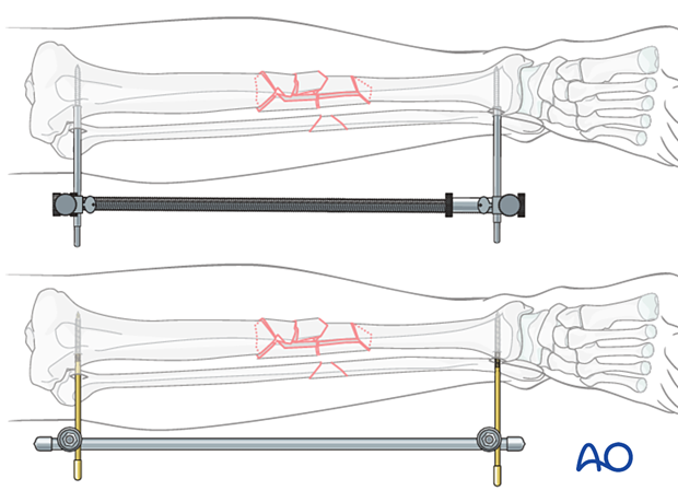 Bridge plating – Reduction aids