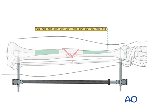 Plate length is based upon symmetry above and below the fracture zone. At least 3-4 screw holes on either side of the fracture.