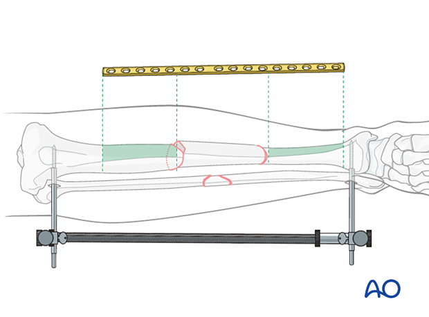 Bridge plating – Choice of implant