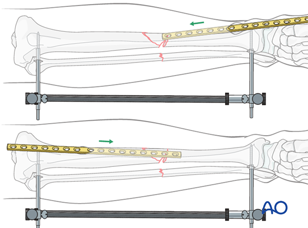 Bridge plating, plate insertion