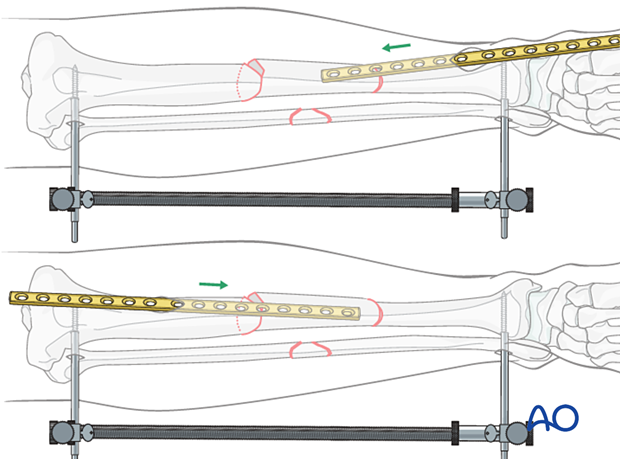 Bridge plating – Plate insertion