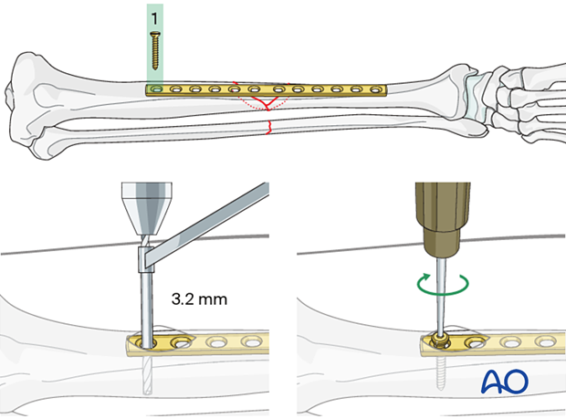 Bridge plating, insertion of the first screw