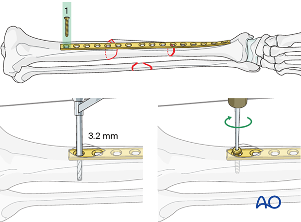 Bridge plating – Insertion of first screw