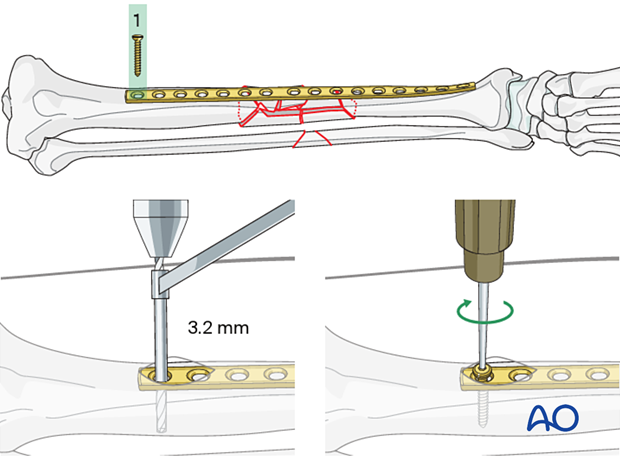 Bridge plating – Insertion of first screw