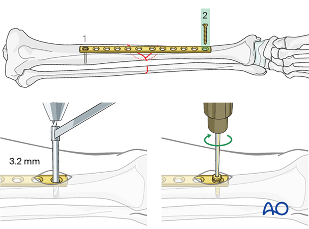 Bridge plating, Insertion of the second (distal) screw