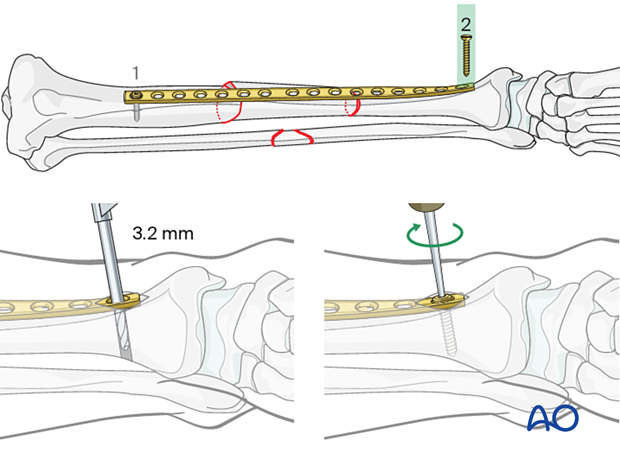 Bridge plating – Insertion of the second screw